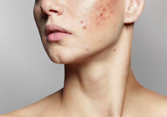 Active breakouts, acne scarring, uneven texture effective treatment
