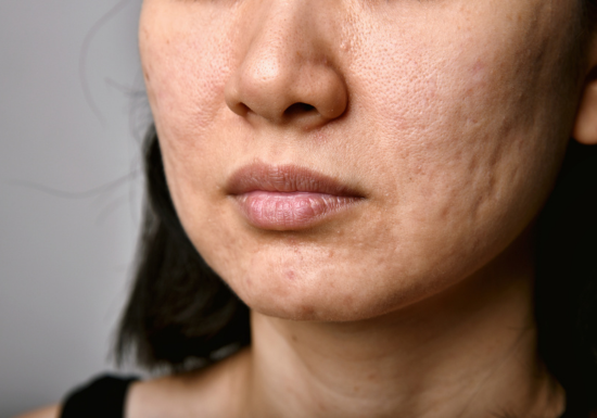 Medical Treatments for Acne and Acne Scars