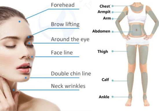 RF Facial Lifting and Tightening