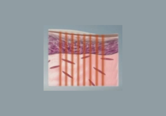 Fractional laser resurfacing option