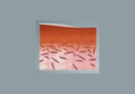 How Laser Skin Resurfacing Works?