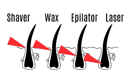 Laser-Hair-Removal