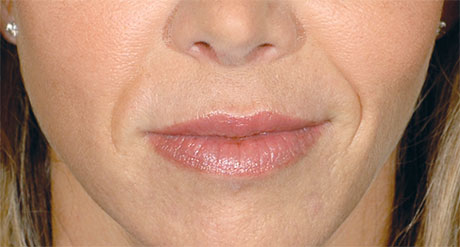 Is Restylane really effective to treat wrinkles?