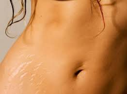 Tips for Stretch Marks Removal Without Surgery