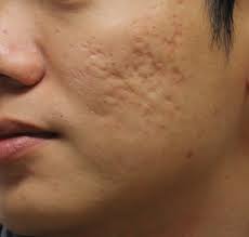 The Different Types of Acne and Acne Treatments