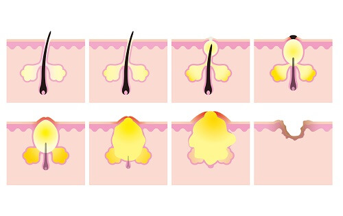 pimples-small