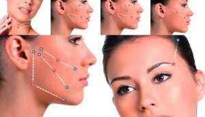 Silhouette Soft thread lift