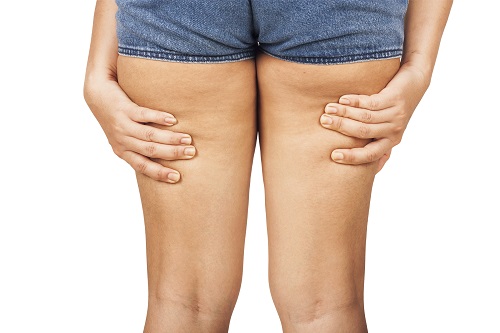 Thigh Slimming Through CoolSculpting