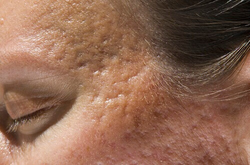pores