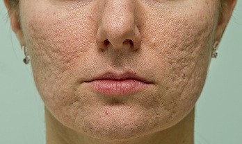 Unwanted Acne Scars Get the Laser Treatment