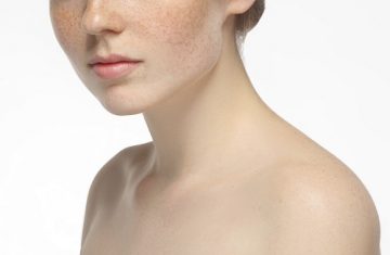 Top 3 Clear Solutions to Hyperpigmentation