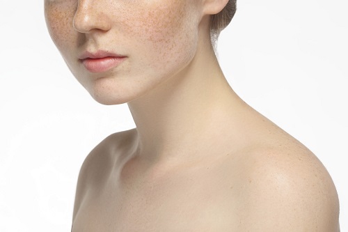 Top 3 Clear Solutions to Hyperpigmentation