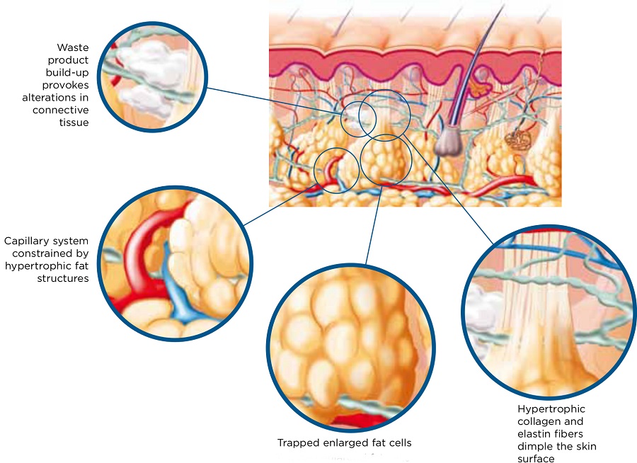 Cellulite reduction