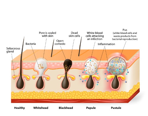 What Really Causes Acne What Really Causes Acne