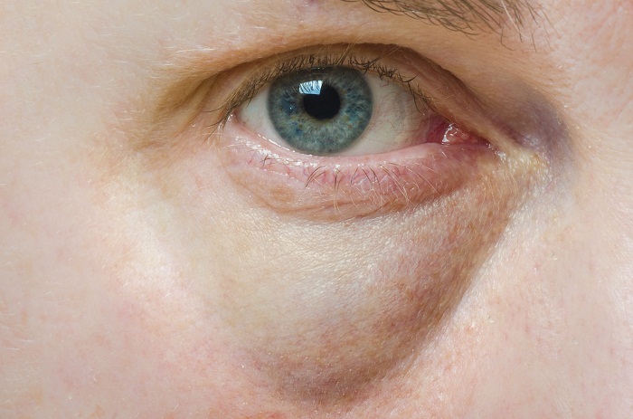 eye wrinkles treatment