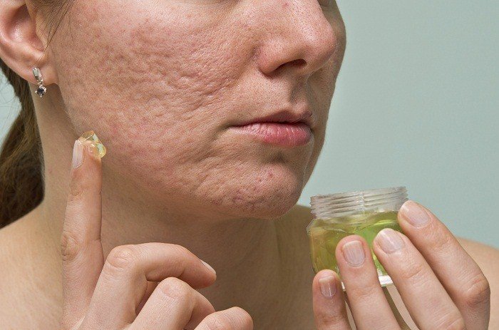 3 Reasons Why You Don’t Have to Live With Acne Scars