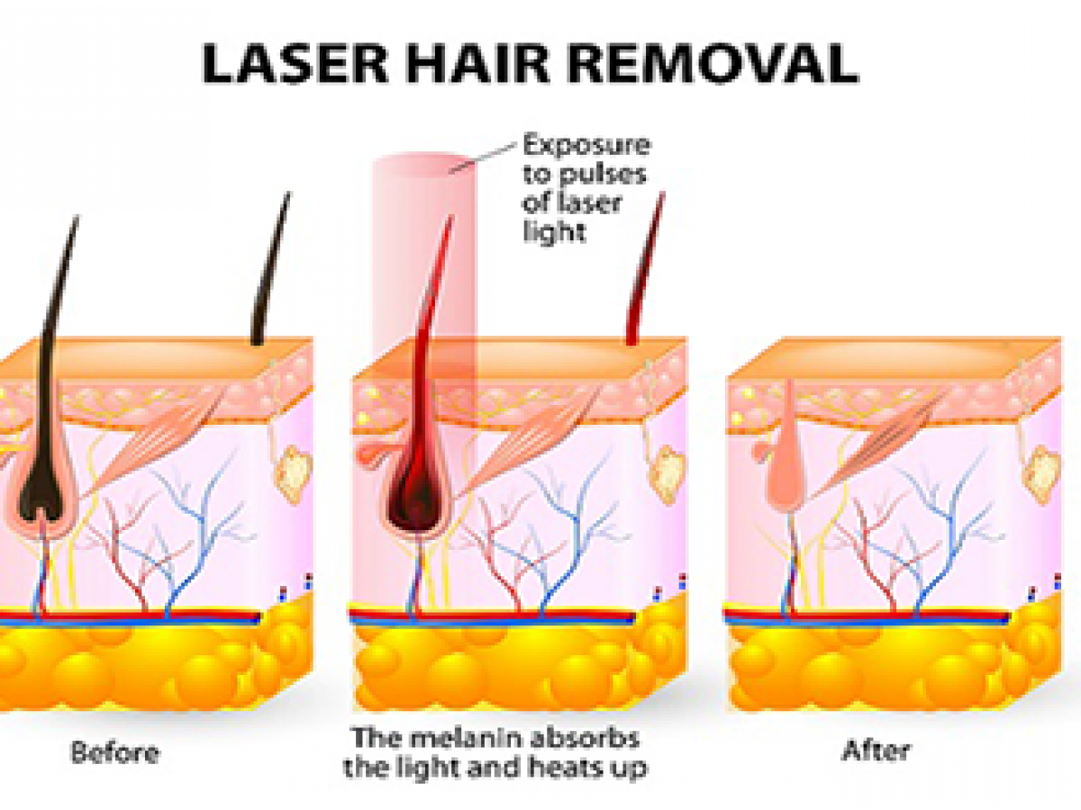 laser