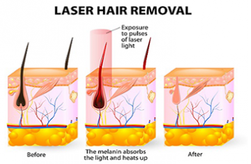 Understanding Hair Growth Cycles and Their Effects on Laser & IPL Hair Removal