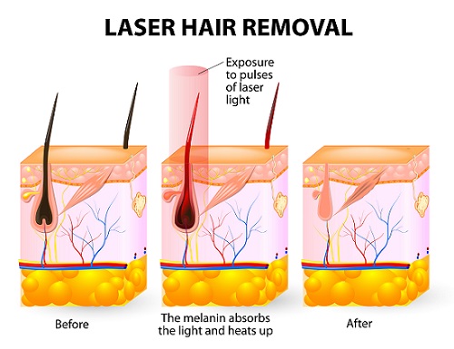 The Pros and Cons of At-Home Laser Hair Removal – Cleveland Clinic
