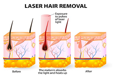 Understanding Hair Growth Cycles and Their Effects on Laser & IPL Hair Removal