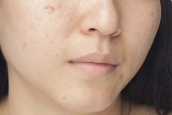 Does Stress Cause Acne? A Mind-Skin Connection Approach in Treating Acne