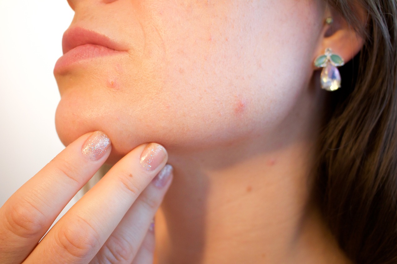 AcneTreatments