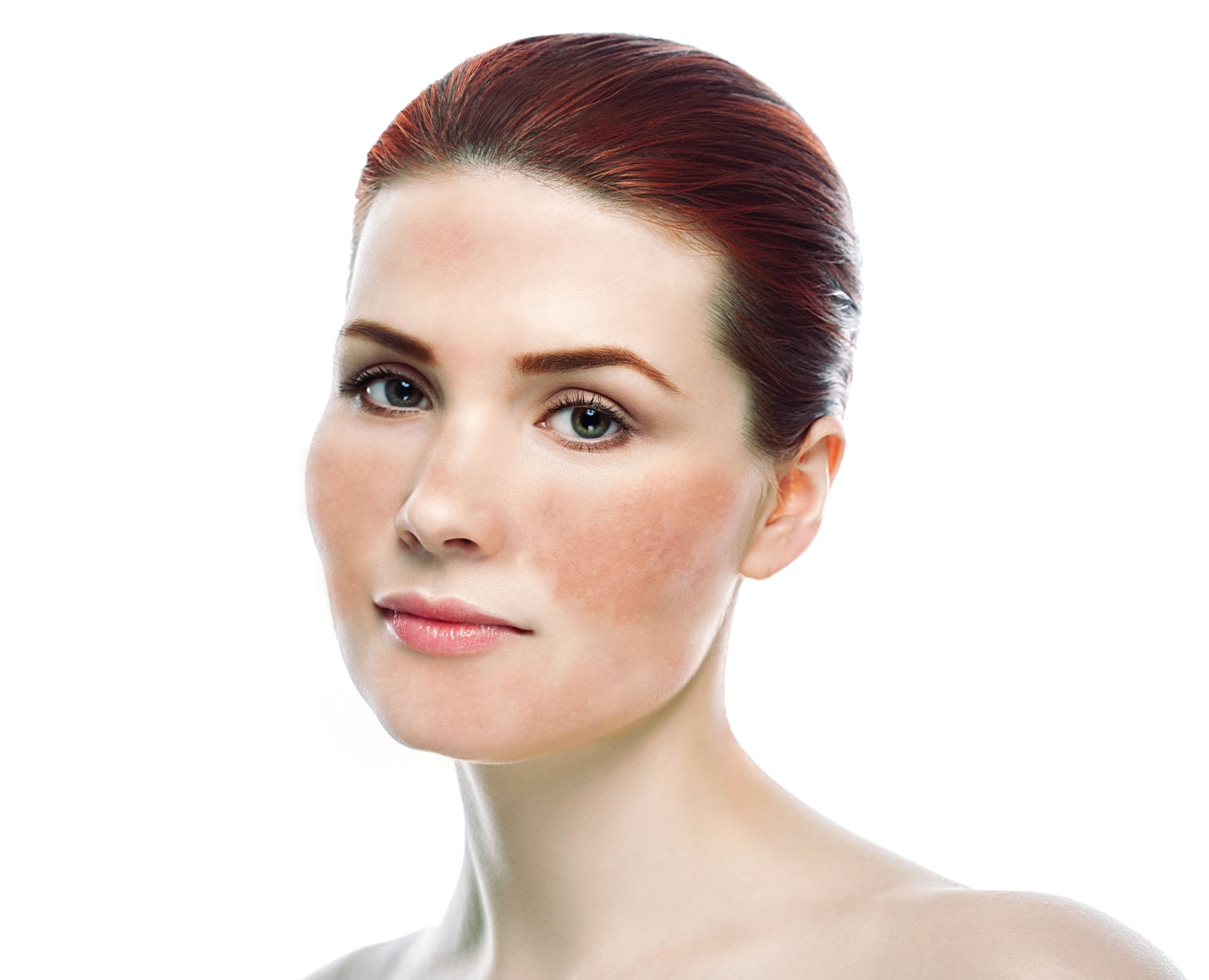 Melasma