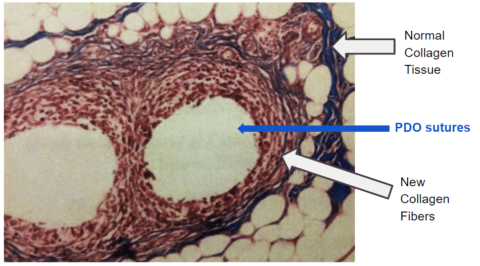 Cutis-PDO-Thread-Lift-Presentation