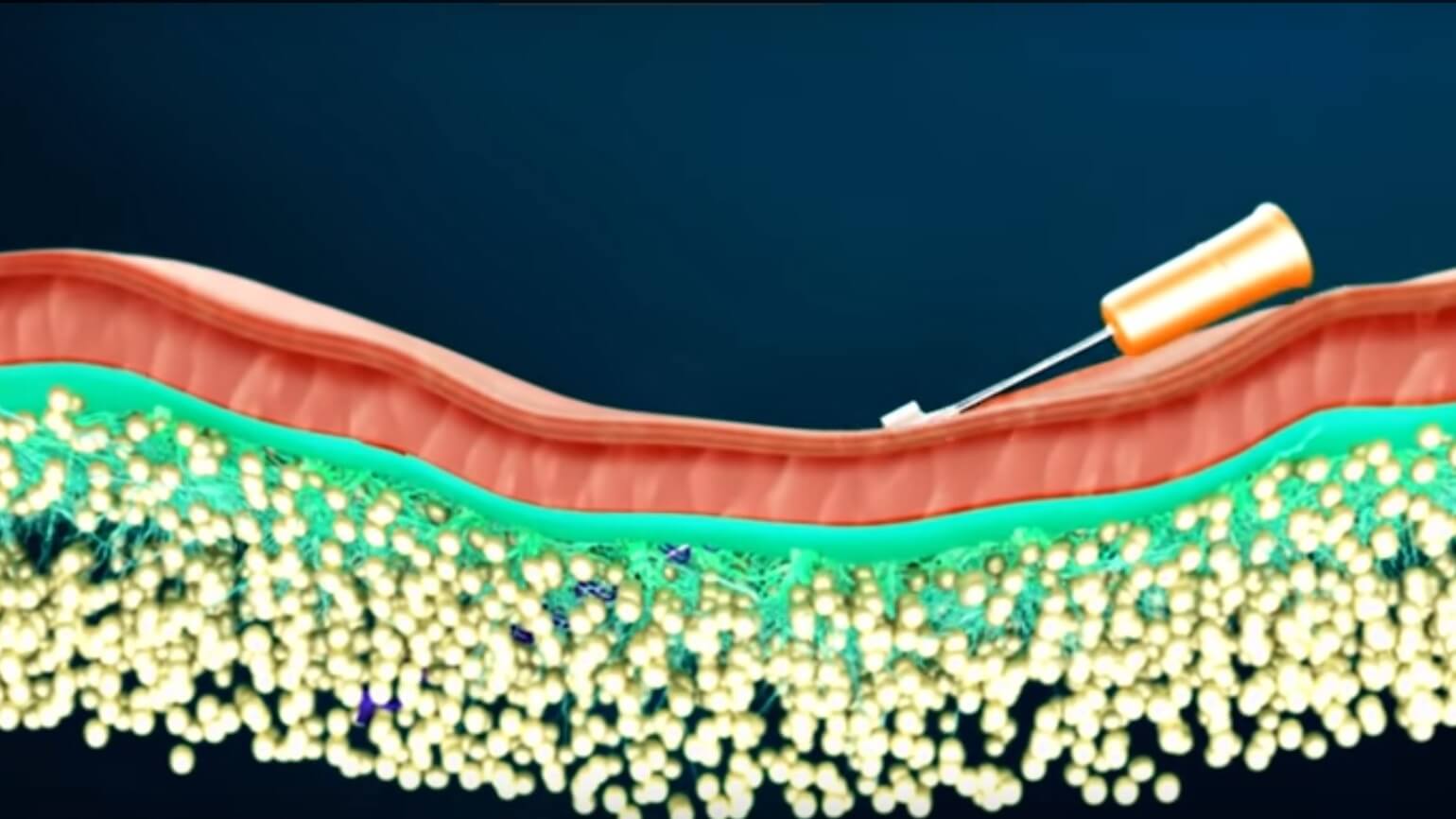 cutis-pdo-thread-lift