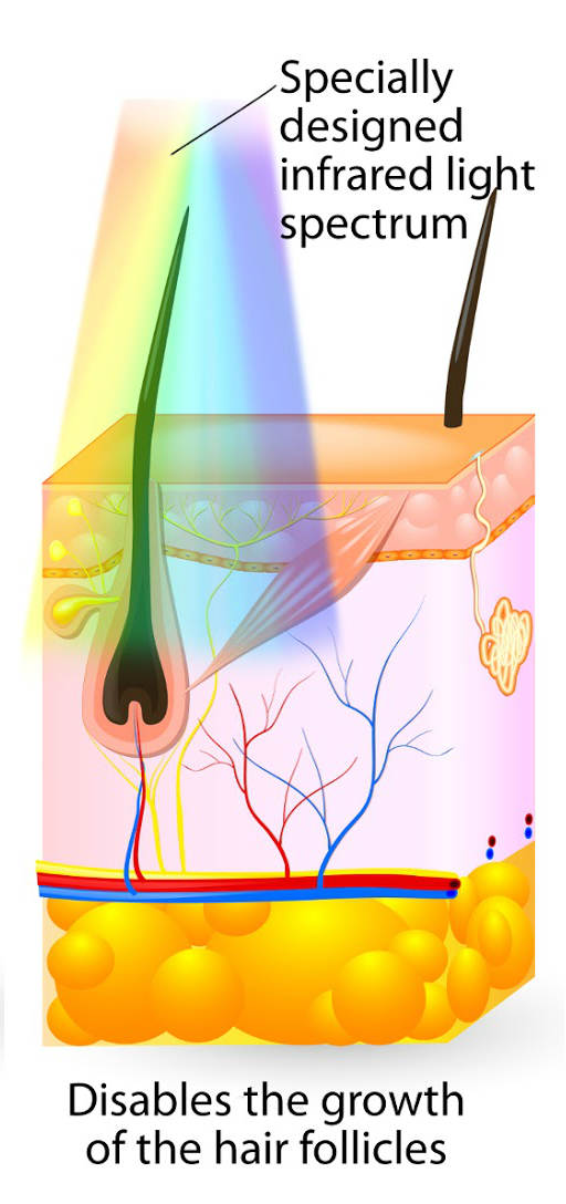 IPL Hair Removal