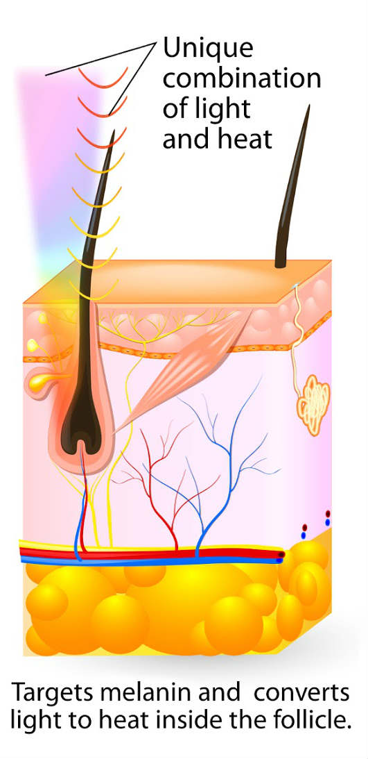 LHE Hair Removal