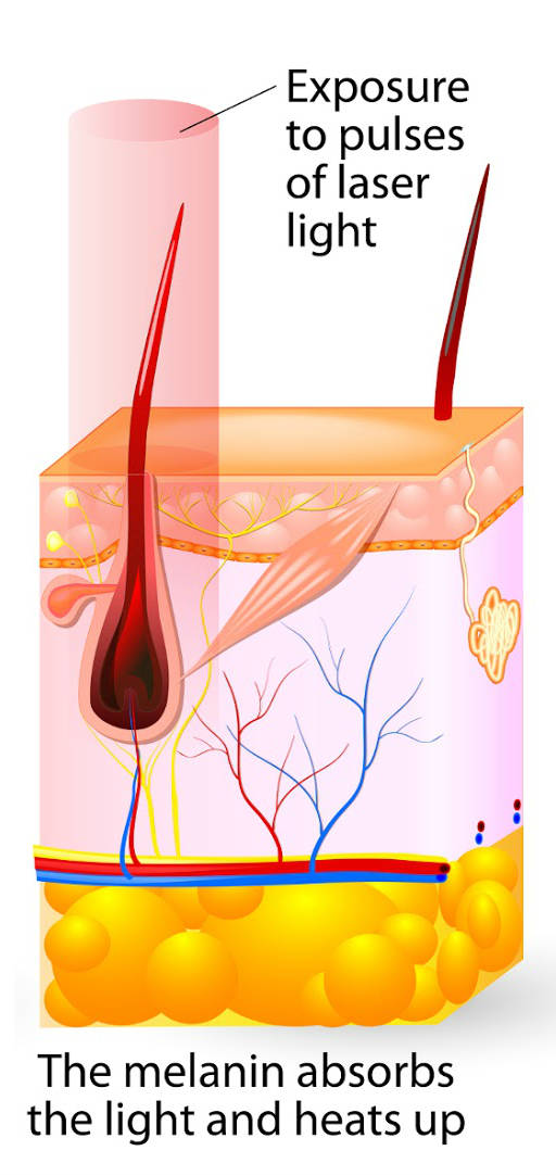 lasser hair removal