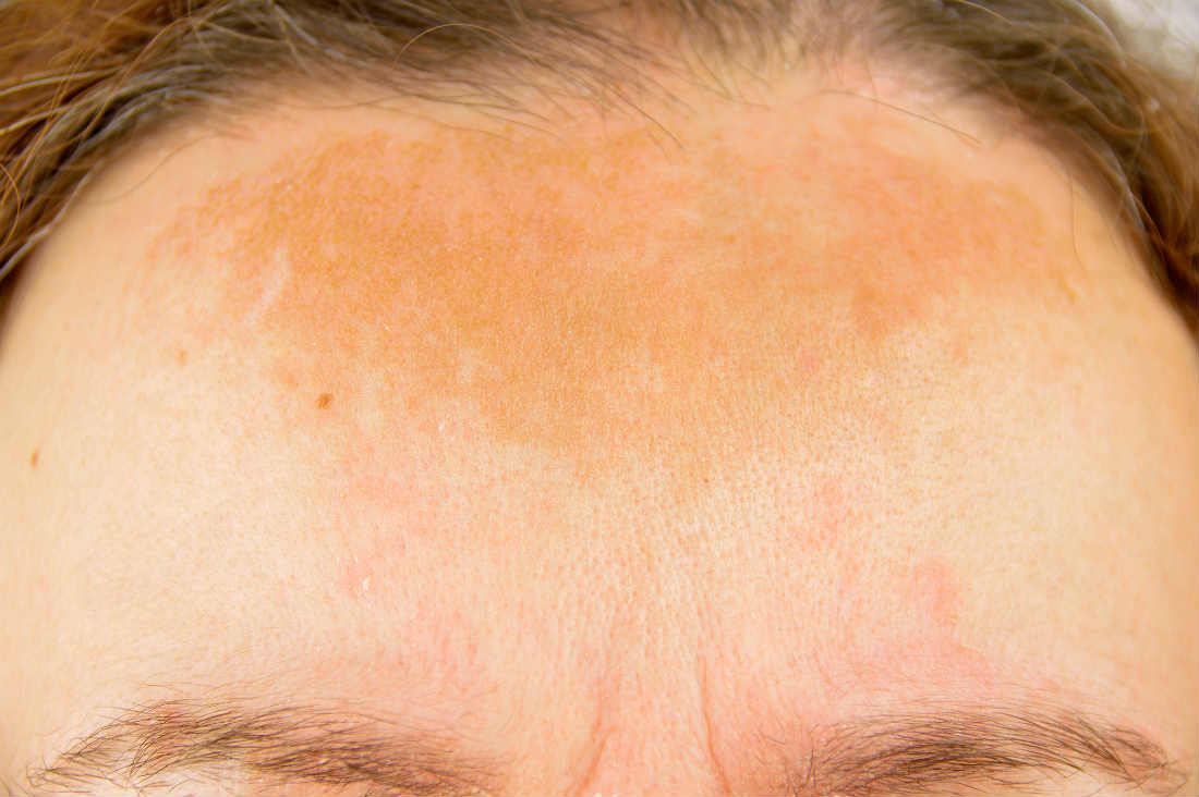 What Is Melasma and How Can You Remove It?