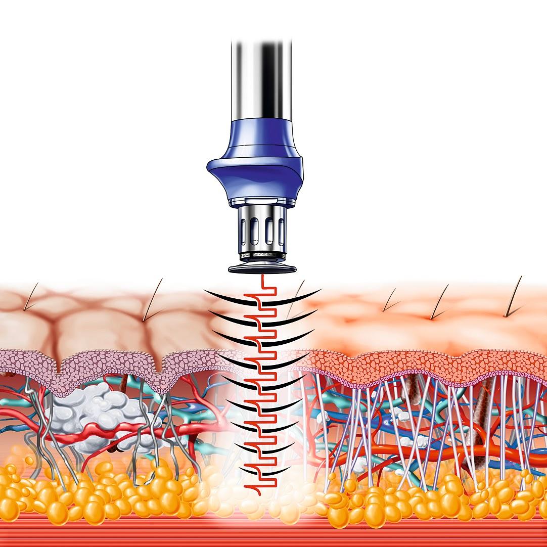 Acoustic Shockwave BTL XWave & Z Wave Cellulite Removal Singapore