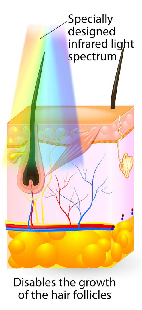 IPL Hair Removal