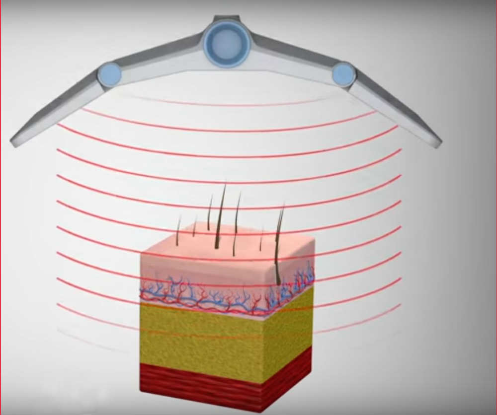 How Does Radiofrequency Remove Fat?