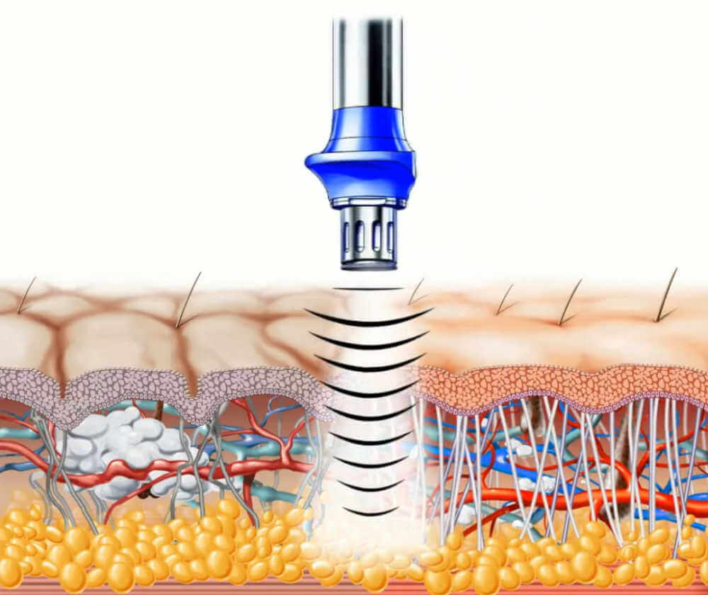 BTL XWave The Proven Cellulite Reduction Treatment in Singapore