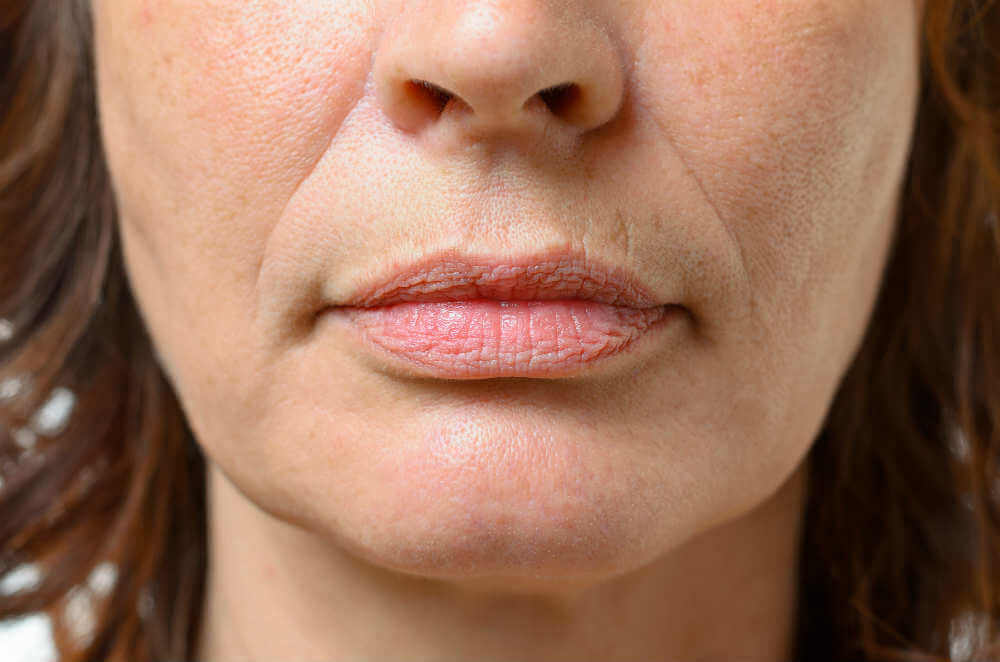 Removing-Lines-Around-Your-Mouth