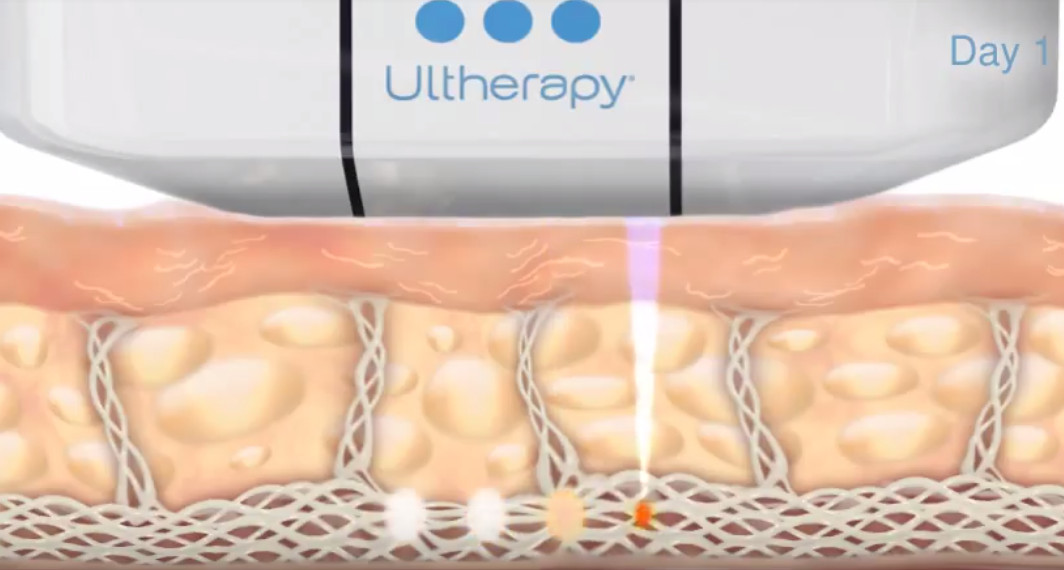 Ultherapy how it works