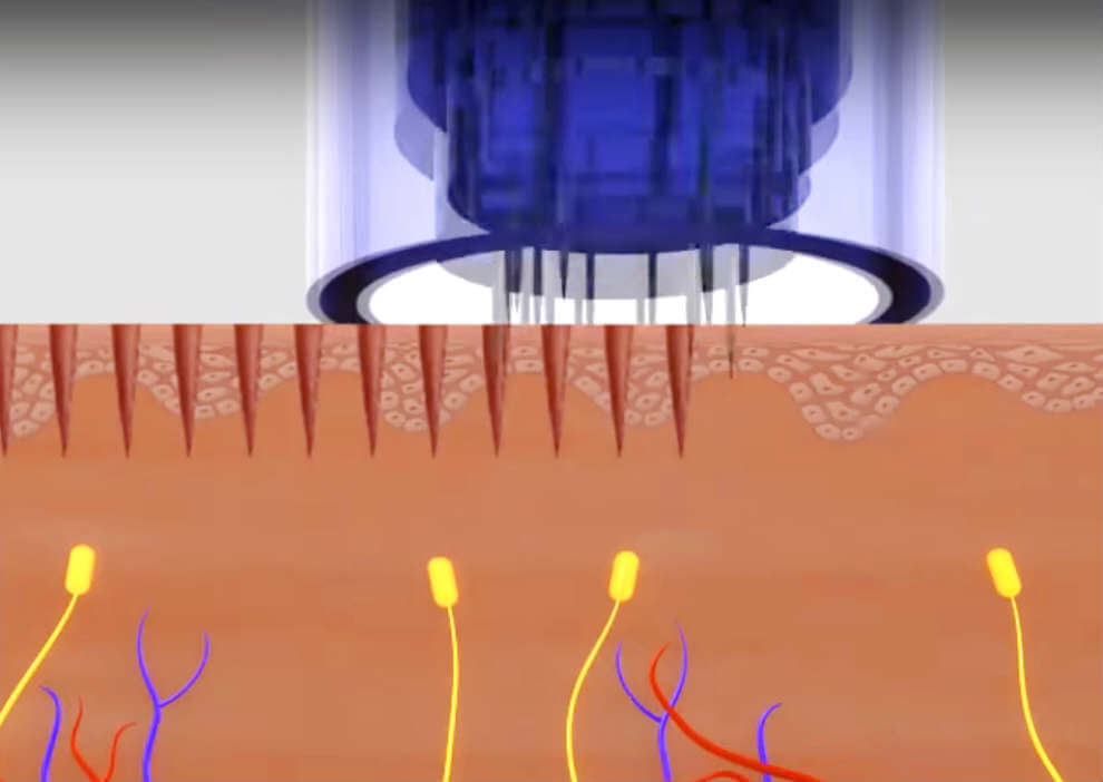 How-Does-the-Dermapen-Work