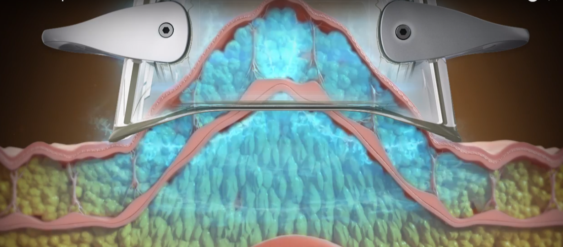 Cryolipolysis Fat Freezing Procedure