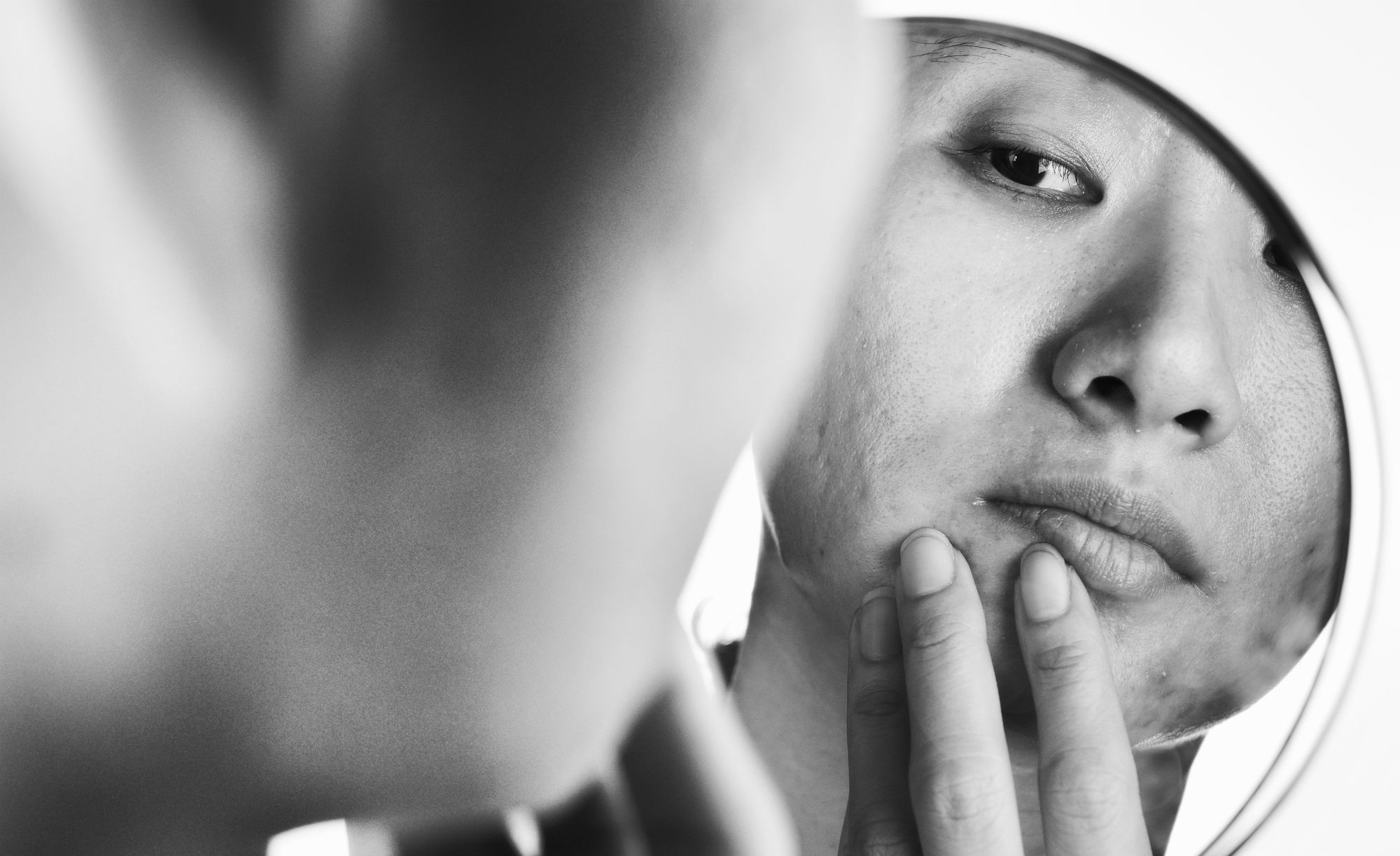 How to get rid of acne: 7 ways that every teenager should know How to get rid of acne: 7 ways that every teenager should know