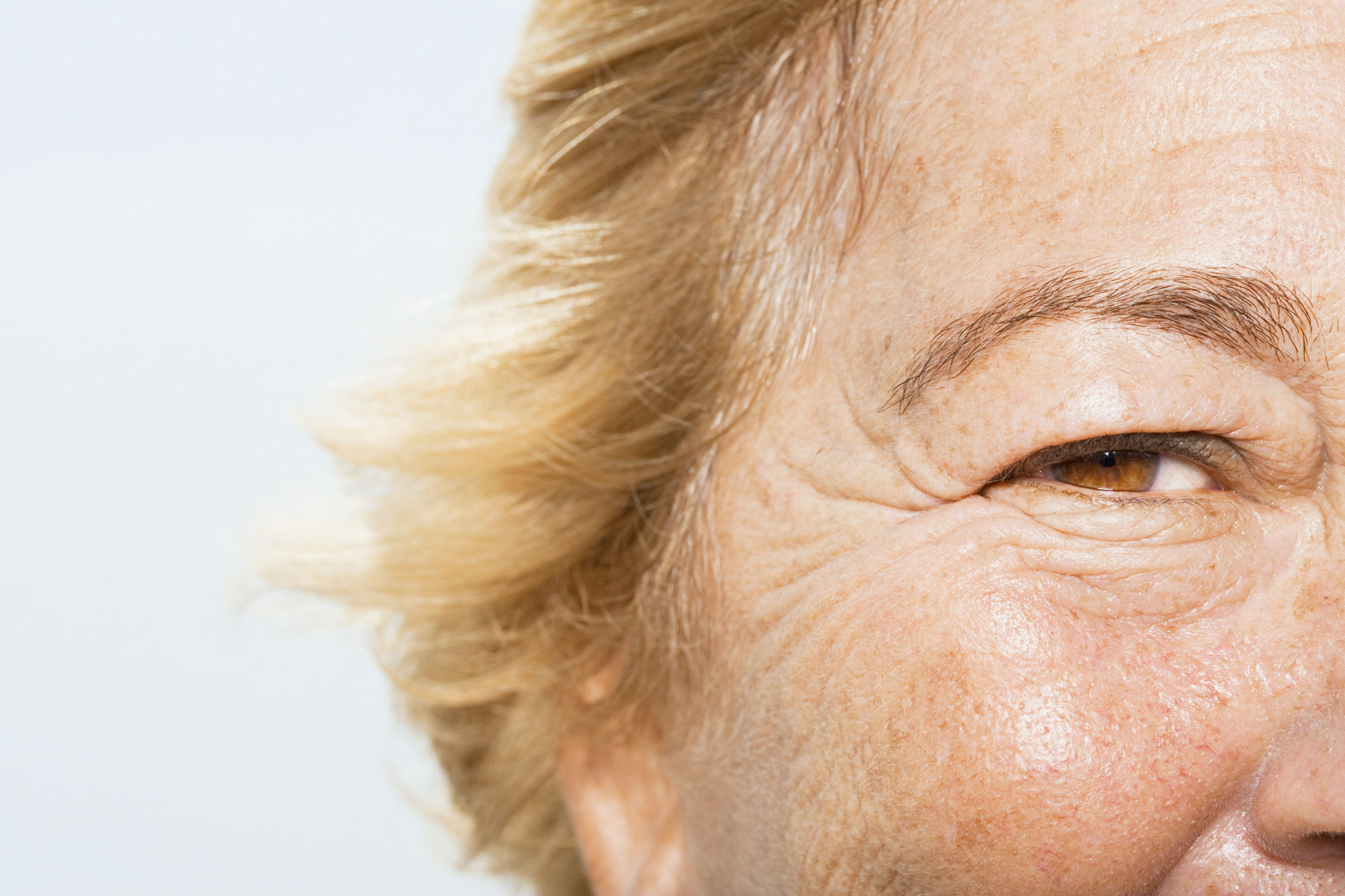 What Type of Wrinkles Do You Have? And How to Treat Them?