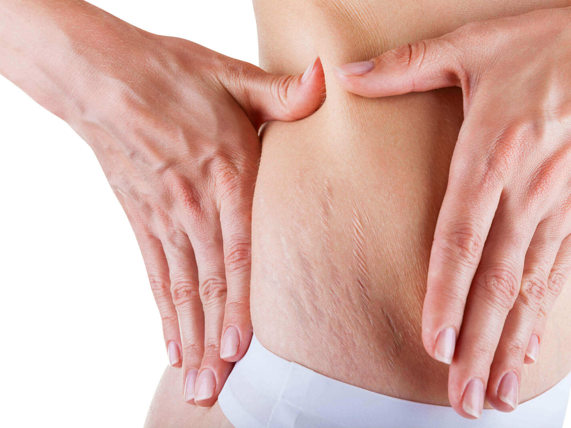 Can You Get Rid of Stretch Marks