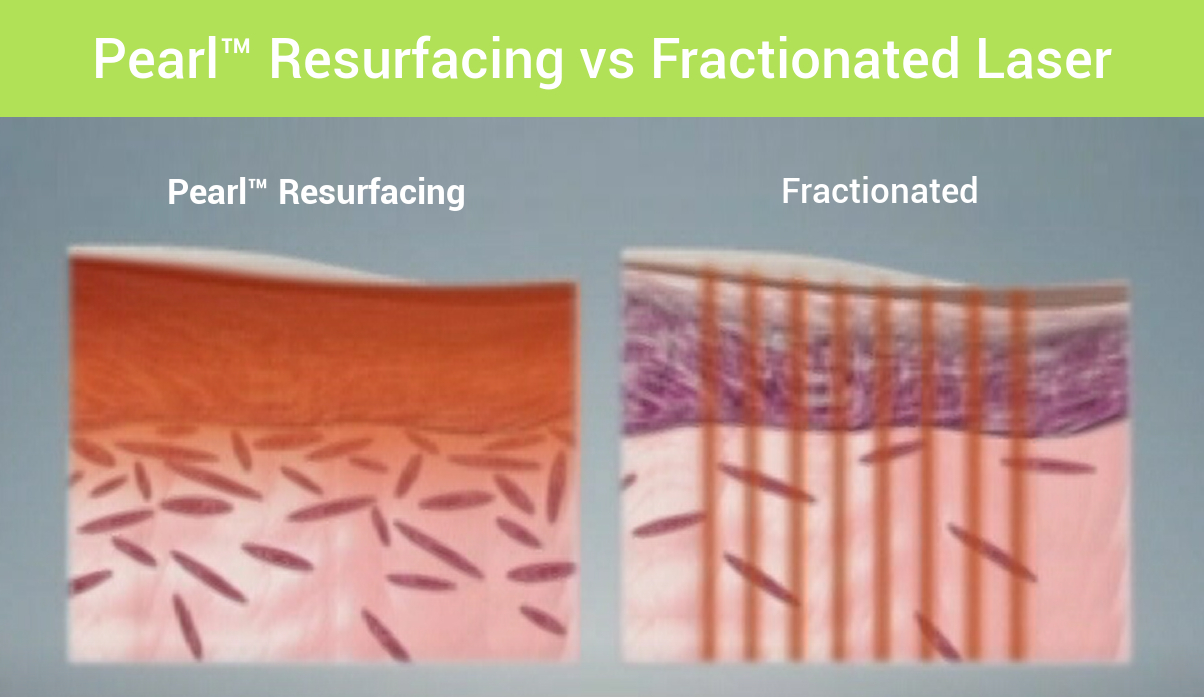 What’s the Difference Between Pearl Resurfacing and Fractional Laser