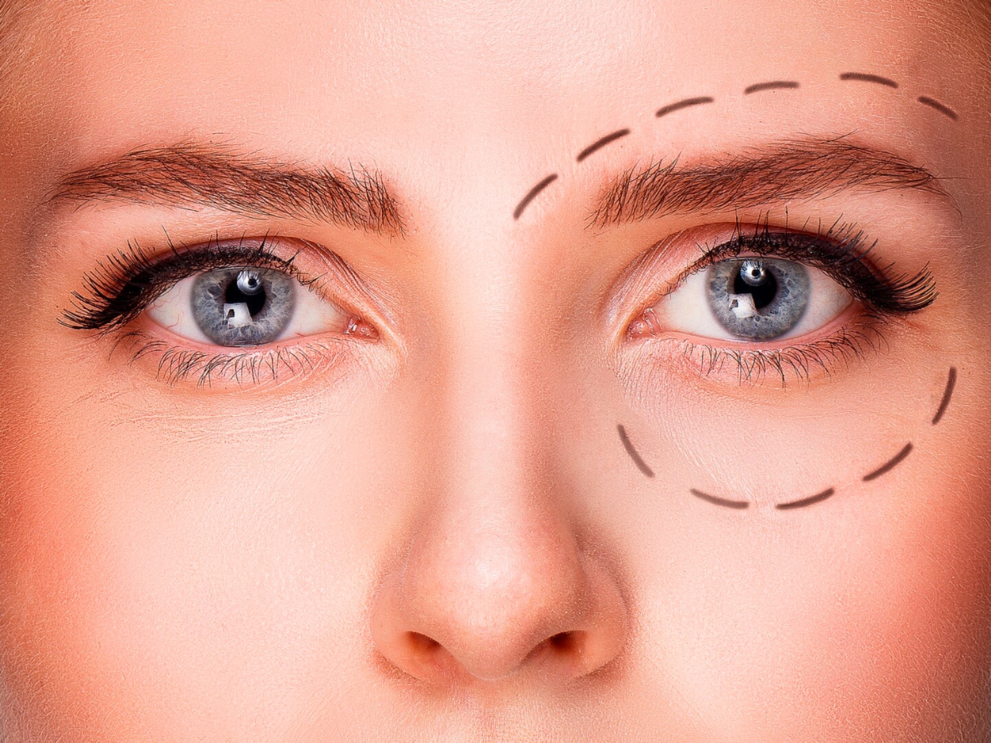 Bothered by Droopy Eyelids? Here Are 3 Alternatives to Eye Surgery