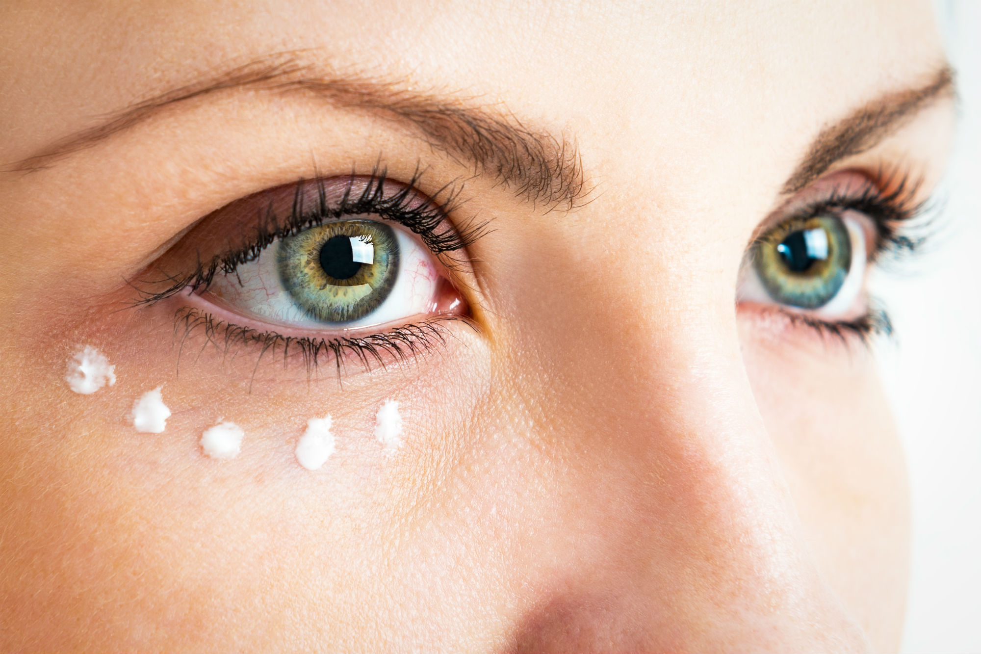 4 Effective Treatments to Remove Dark Under Eye Circles