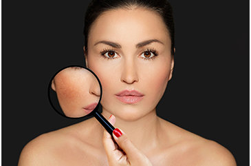 What Causes Melasma and What Can You Do About it?