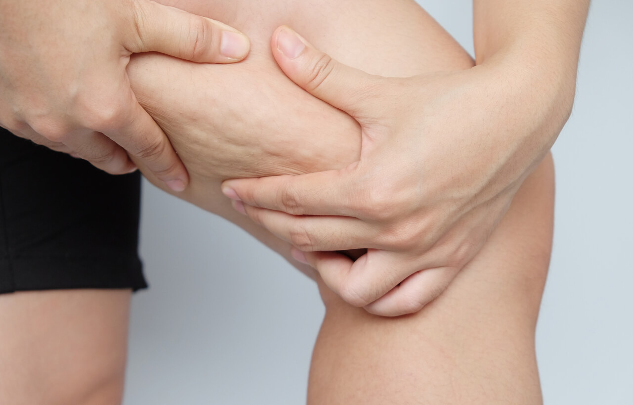 Why Do I Have Cellulite? And How Can It Be Effectively Treated?