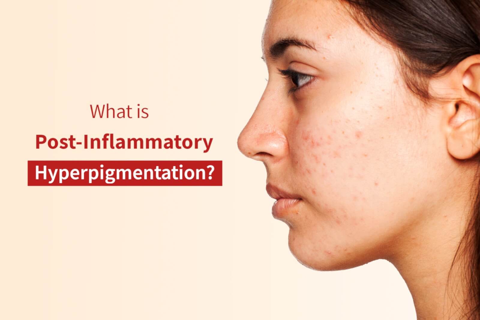 What is Post-Inflammatory Hyperpigmentation? Know the Causes and Effective Treatments